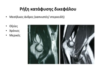 Ρήξη κατάφυσης δικεφάλου 
• Μεσήλικες άνδρες (καπνιστές/ στεροειδή) 
• Οξείες 
• Χρόνιες 
• Μερικές 
 