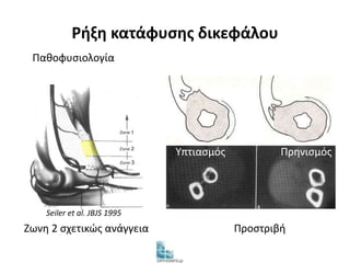 Ρήξη κατάφυσης δικεφάλου 
Υπτιασμός Πρηνισμός 
Παθοφυσιολογία 
Seiler et al. JBJS 1995 
Ζωνη 2 σχετικώς ανάγγεια Προστριβή 
 