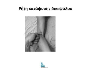 Ρήξη κατάφυσης δικεφάλου 
 