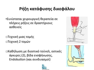 Ρήξη κατάφυσης δικεφάλου 
▪Συνίσταται χειρουργική θεραπεία σε 
πλήρεις ρήξεις σε δραστήριους 
ασθενείς 
□Τεχνική μιας τομής 
□Τεχνική 2 τομών 
□Καθήλωση με διοστικό τούνελ, οστικές 
άγκυρες (2), βίδα ενσφήνωσης, 
Endobutton (και συνδυασμοί) 
 