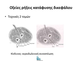 Οξείες ρήξεις κατάφυσης δικεφάλου 
• Τεχνικές 2 τομών 
Two-incision 
Κίνδυνος: κερκιδωλενική συνοστέωση 
Boyd & Anderson Modified Moorey 
 