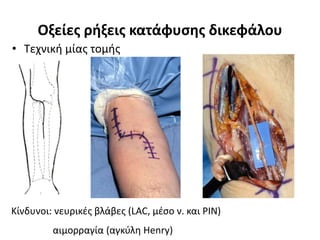 Οξείες ρήξεις κατάφυσης δικεφάλου 
• Τεχνική μίας τομής 
Κίνδυνοι: νευρικές βλάβες (LAC, μέσο ν. και PIN) 
αιμορραγία (αγκύλη Henry) s 
 