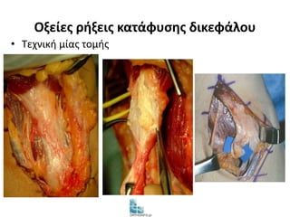 Οξείες ρήξεις κατάφυσης δικεφάλου 
• Τεχνική μίας τομής 
 