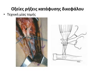 Οξείες ρήξεις κατάφυσης δικεφάλου 
• Τεχνική μίας τομής 
 