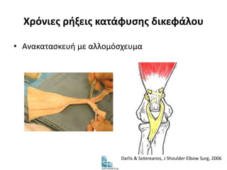 Χρόνιες ρήξεις κατάφυσης δικεφάλου 
• Ανακατασκευή με αλλομόσχευμα 
Darlis & Sotereanos, J Shoulder Elbow Surg, 2006 
 