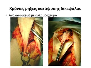 Χρόνιες ρήξεις κατάφυσης δικεφάλου 
• Ανακατασκευή με αλλομόσχευμα 
 