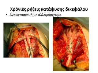 Χρόνιες ρήξεις κατάφυσης δικεφάλου 
• Ανακατασκευή με αλλομόσχευμα 
 