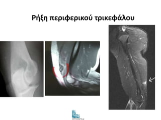 Ρήξη περιφερικού τρικεφάλου 
 