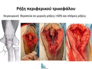 Ρήξη περιφερικού τρικεφάλου 
Χειρουργική θεραπεία σε μερικές ρήξεις >50% και πλήρεις ρήξεις 
 
