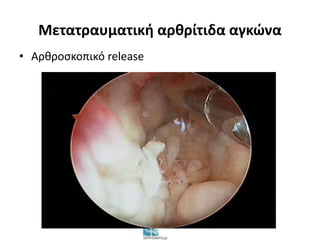 Μετατραυματική αρθρίτιδα αγκώνα 
• Αρθροσκοπικό release 
 