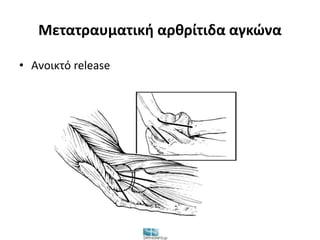 Μετατραυματική αρθρίτιδα αγκώνα 
• Ανοικτό release 
 