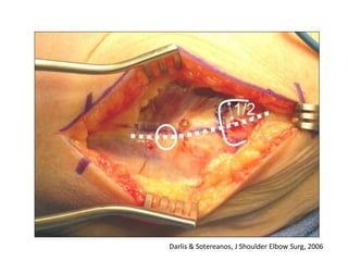 Darlis & Sotereanos, J Shoulder Elbow Surg, 2006 
 