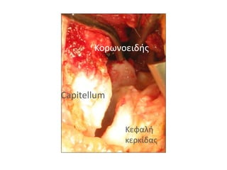 Κορωνοειδής 
Capitellum 
Κεφαλή 
κερκίδας 
 