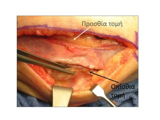 Προσθία τομή 
Οπίσθια 
τομή 
 