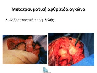 Μετατραυματική αρθρίτιδα αγκώνα 
• Αρθροπλαστική παρεμβολής 
 