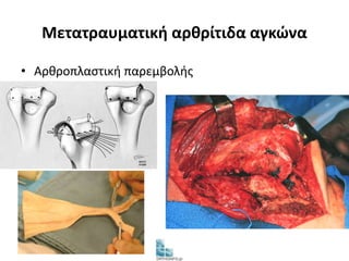 Μετατραυματική αρθρίτιδα αγκώνα 
• Αρθροπλαστική παρεμβολής 
 