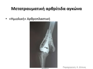 Μετατραυματική αρθρίτιδα αγκώνα 
• «Ημιολική» Αρθροπλαστική 
Παραχώρηση: Κ. Δίτσιος 
 
