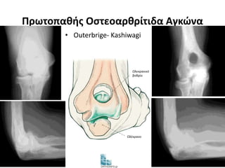 Πρωτοπαθής Οστεοαρθρίτιδα Αγκώνα 
• Outerbrige- Kashiwagi 
Ωλεκρανικό 
βοθρίο 
Ωλέκρανο 
 