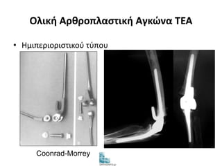 Ολική Αρθροπλαστική Αγκώνα TEA 
• Ημιπεριοριστικού τύπου 
Coonrad-Morrey 
 