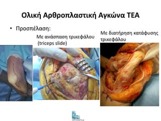 Ολική Αρθροπλαστική Αγκώνα TEA 
• Προσπέλαση: 
Με ανάσπαση τρικεφάλου 
(triceps slide) 
Με διατήρηση κατάφυσης 
τρικεφάλου 
 