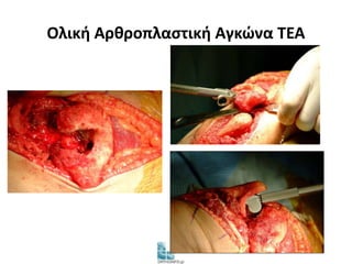Ολική Αρθροπλαστική Αγκώνα TEA 
 