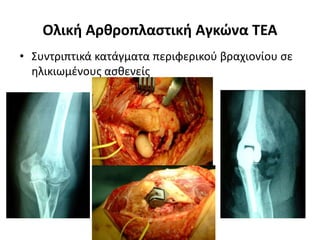 Ολική Αρθροπλαστική Αγκώνα TEA 
• Συντριπτικά κατάγματα περιφερικού βραχιονίου σε 
ηλικιωμένους ασθενείς 
 