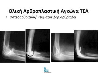 Ολική Αρθροπλαστική Αγκώνα TEA 
• Οστεοαρθρίτιδα/ Ρευματοειδής αρθρίτιδα 
 