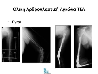 Ολική Αρθροπλαστική Αγκώνα TEA 
• Όγκοι 
 