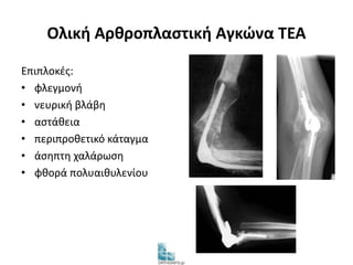 Ολική Αρθροπλαστική Αγκώνα TEA 
Επιπλοκές: 
• φλεγμονή 
• νευρική βλάβη 
• αστάθεια 
• περιπροθετικό κάταγμα 
• άσηπτη χαλάρωση 
• φθορά πολυαιθυλενίου 
 