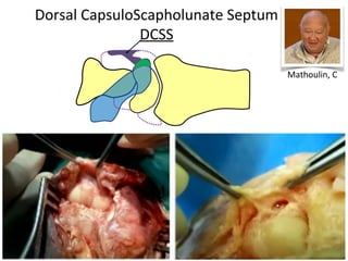 Dorsal CapsuloScapholunate Septum
DCSS
Mathoulin, C
