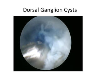 Dorsal Ganglion Cysts