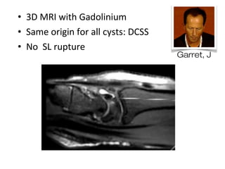 • 3D MRI with Gadolinium
• Same origin for all cysts: DCSS
• No SL rupture
Garret, J