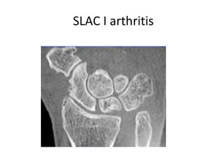 SLAC I arthritis