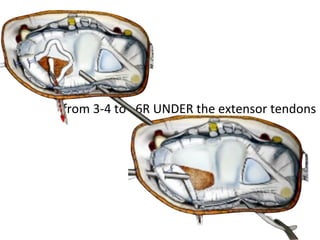 from 3-4 to 6R UNDER the extensor tendons