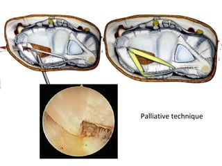 Palliative technique