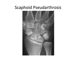 Scaphoid Pseudarthrosis