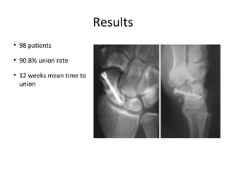 Results
• 98 patients
• 90.8% union rate
• 12 weeks mean time to
union