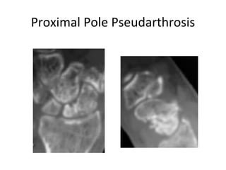 Proximal Pole Pseudarthrosis