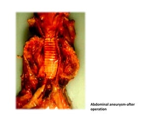 Abdominal aneurysm-after
operation
 