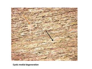Cystic medial degeneration
 