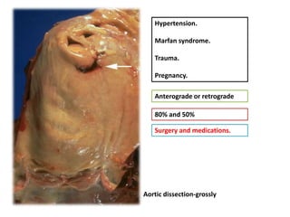 Hypertension.

   Marfan syndrome.

   Trauma.

   Pregnancy.

   Anterograde or retrograde

   80% and 50%

   Surgery and medications.




Aortic dissection-grossly
 