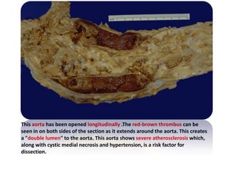This aorta has been opened longitudinally .The red-brown thrombus can be
seen in on both sides of the section as it extends around the aorta. This creates
a "double lumen" to the aorta. This aorta shows severe atherosclerosis which,
along with cystic medial necrosis and hypertension, is a risk factor for
dissection.
 