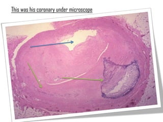 This was his coronary under microscope
 
