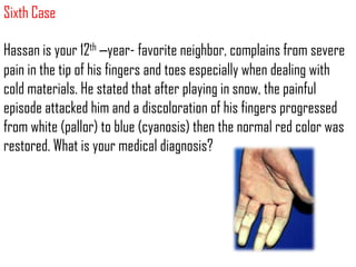 Sixth Case

Hassan is your 12th –year- favorite neighbor, complains from severe
pain in the tip of his fingers and toes especially when dealing with
cold materials. He stated that after playing in snow, the painful
episode attacked him and a discoloration of his fingers progressed
from white (pallor) to blue (cyanosis) then the normal red color was
restored. What is your medical diagnosis?
 