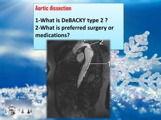 Aortic dissection
1-What is DeBACKY type 2 ?
2-What is preferred surgery or
medications?
 