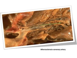 Atherosclerosis-coronary artery
 