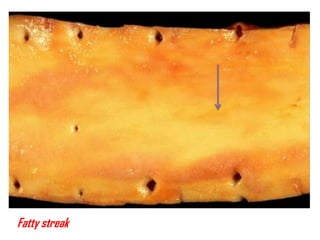 Fatty streak
 