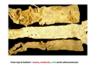 From top to bottom : severe, moderate, mild aortic atherosclerosis.
 