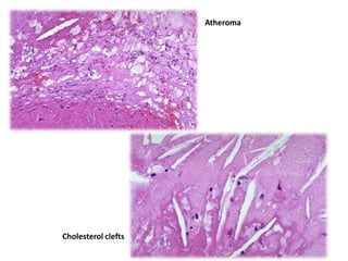 Atheroma




Cholesterol clefts
 