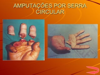 AMPUTAÇÕES POR SERRA CIRCULAR 